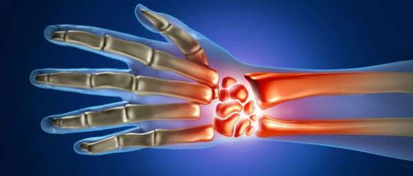 Причины и лечение артрита лучезапястного сустава